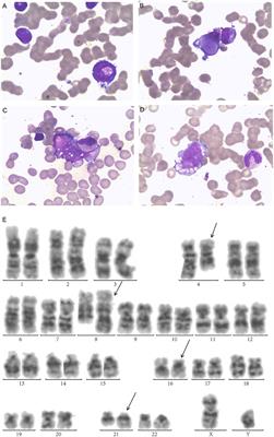 Donor-Derived CD123-Targeted CAR T Cell Serves as a RIC Regimen for Haploidentical Transplantation in a Patient With FUS-ERG+ AML